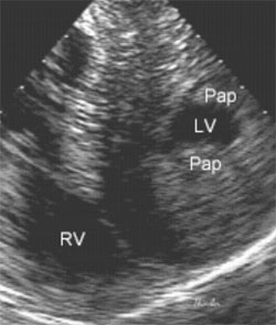 Echocardiogram showing severe LVH