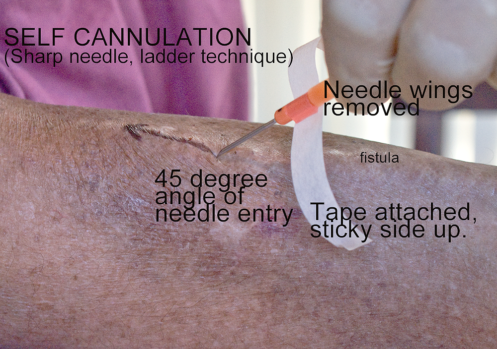 needle-angle