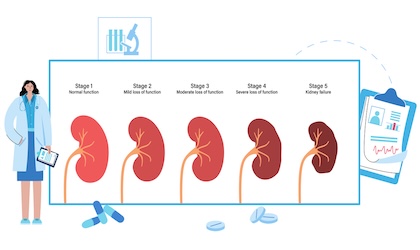 Kidney disease concept Stages of development of renal failure