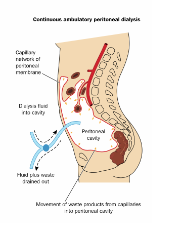 peritoneal dialysis diagram