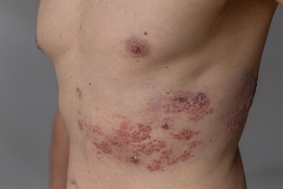 Shingles (Herpes Zoster) Rash on an Adult Male Torso