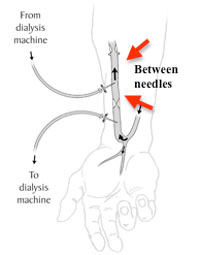 Fistula diagram