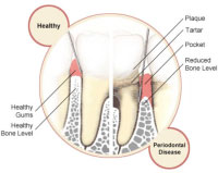 Tooth decay