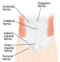 Hernia