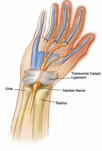 Carpal Tunnel Syndrome