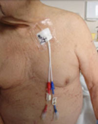 Man with chest catheter