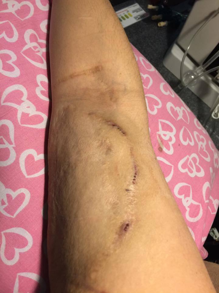 Legs on sex bruises Unexplained Bruising
