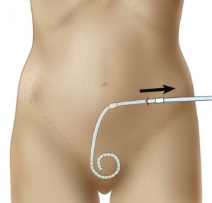 Abdominal Catheter