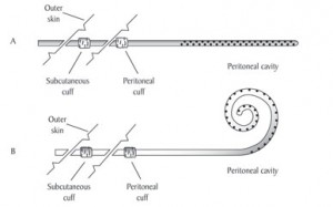 Illustrazione del catetere