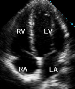 Normal echocardiogram (left ventricle at LV)