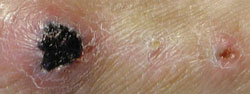 Scab that will not heal