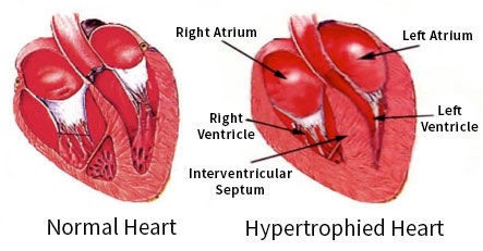 Hypertrophied Heart