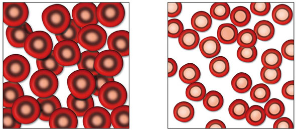 Iron Deficiency with Anemia