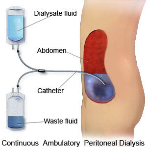 dialysis peritoneal pd ambulatory continuous kidney fluid capd catheter diagram works central care renal filter peritoneum davita diet hospital machine