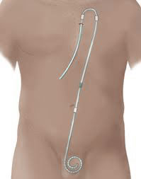 Presternal Catheter