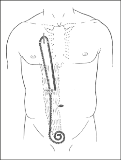 Drawing of presternal catheter